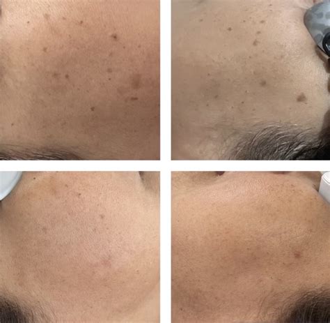 Sunspots On Face Treatment