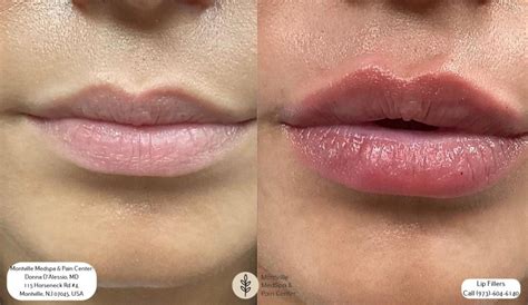 Purple Lips After Lip Fillers - Infoupdate.org