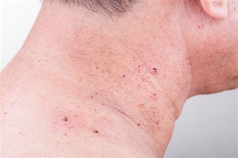 Mole Removal With Minimal Scarring at Donald Peterson blog