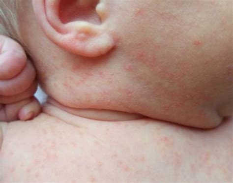 Потница у детей: фото, симптомы и лечение в домашних условиях