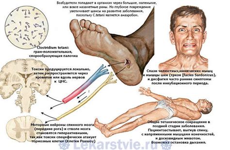 Столбняк: симптомы у человека, прививка от столбняка когда делают ...
