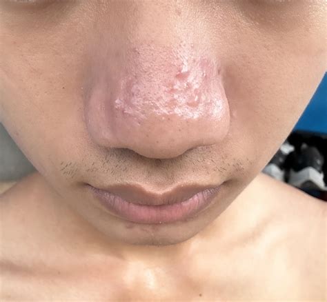 How to make my nose clear : r/acne