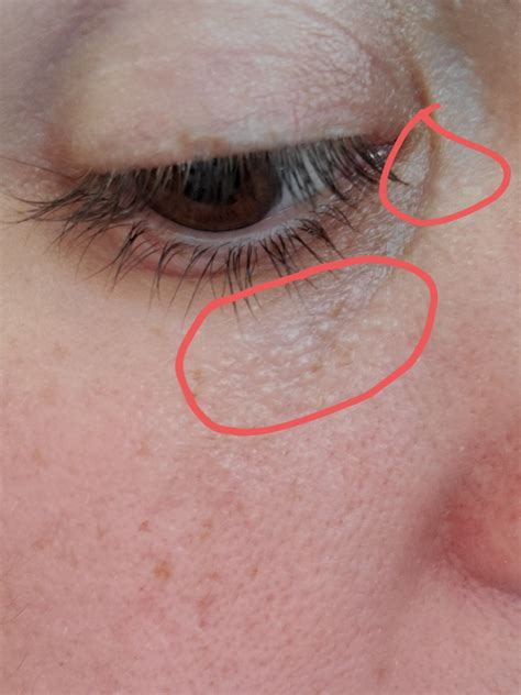 Small Bubbles Under Eyes at Matthew Mendelsohn blog