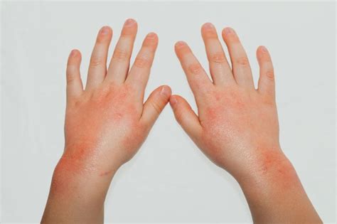 mengenal penyakit scabies   dialami santri penyebab gejala