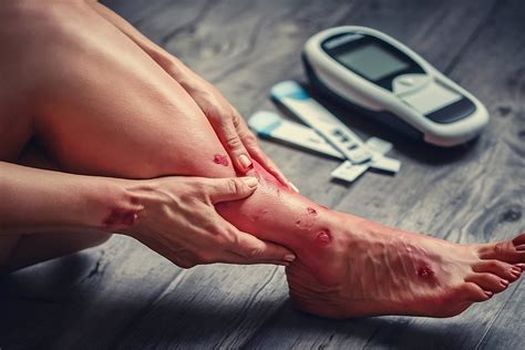 Foot Wound Care for Diabetics and Ulcers | Foot & Ankle Specialty Centers