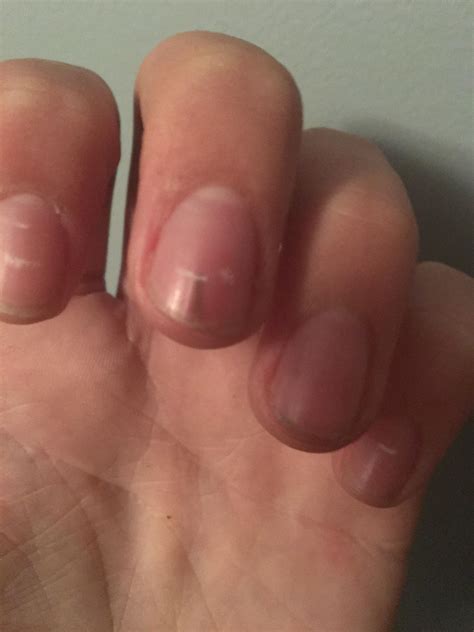 Getting a sliver under my nail : r/HadToHurt