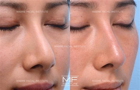 does weight loss make your nose smaller 2