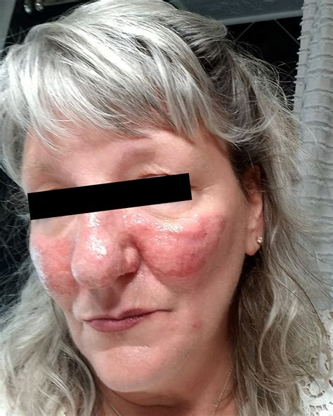 Patient Photos | Rosacea.org