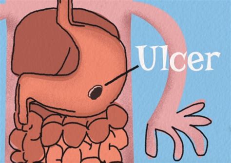 What Causes Stomach Ulcers? | Mind Detour