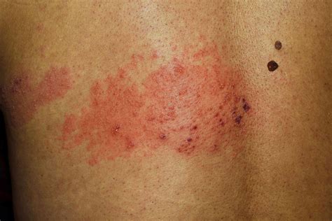 What Does Shingles Look Like? 5 Signs to Watch For