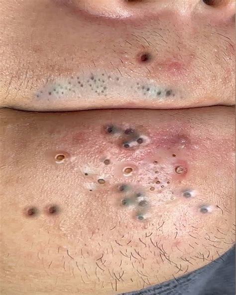 Blackheads - Says Yes Before Open Watch https://bestvideoso.com/dena/dr