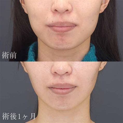 エラのボトックス注射の症例写真・ビフォーアフター Ι 執刀医：杉島 慎太郎 Ι 美容整形なら水の森美容クリニック