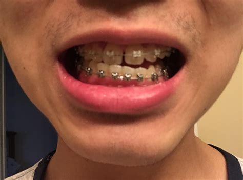 One side of Bottom Teeth Higher than the other. Can this be fixed with