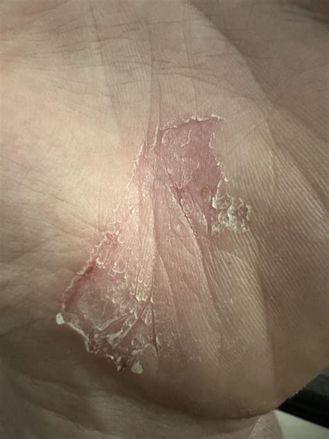 Dead (skin) spreading on palm : r/DermatologyQuestions