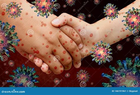 Doenças virais ilustração stock. Ilustração de dermatologia - 146191961