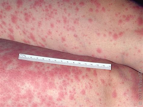 Stevens-Johnson Syndrome: Symptoms, Pictures, Causes, Treatments - GoodRx
