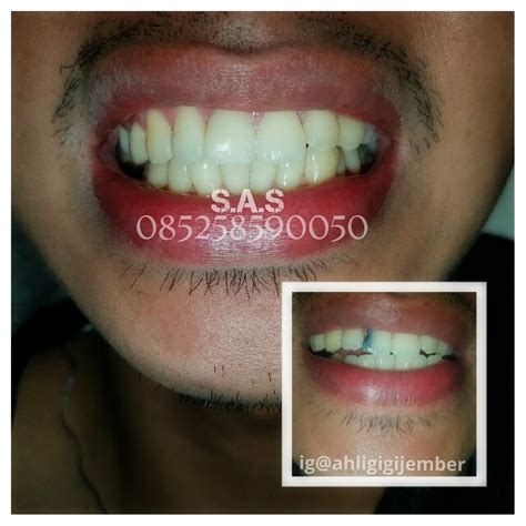 cara mengatasi gigi impaksi tanpa operasi 10