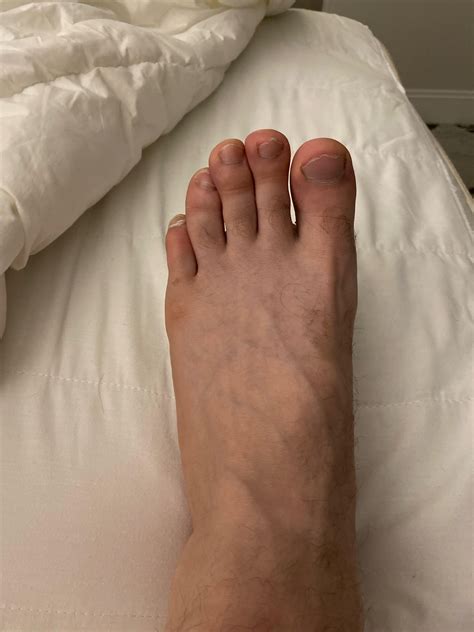 Is this a tailors bunion? I have the exact same thing on the other foot