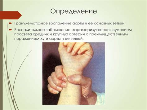 Болезнь Такаясу (неспецифический аортоартериит, синдром дуги аорты ...