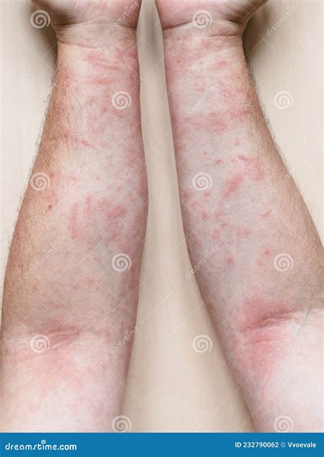 Male Arms With Itchy Red Rash Royalty-Free Stock Image | CartoonDealer
