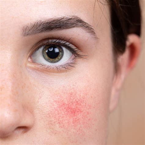 Lupus: Tiché onemocnění, které může změnit váš život!