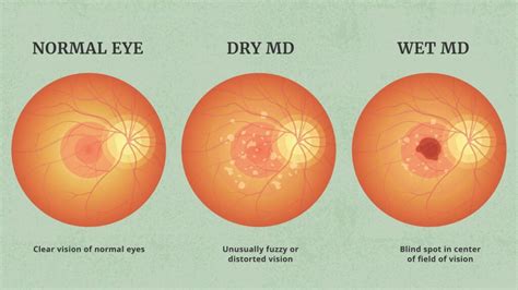 understanding macular degeneration   nurse expert