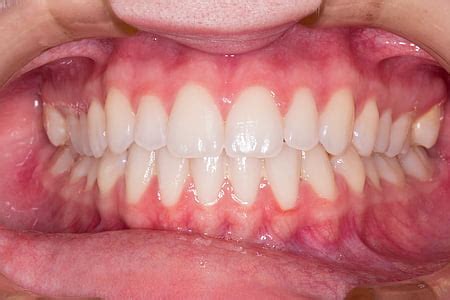 royalty  photo persons teeth pickpik