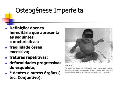 Osteogênese Imperfeita Tipo 1 - PPT - Osteogênese Imperfeita PowerPoint Presentation, free download ...