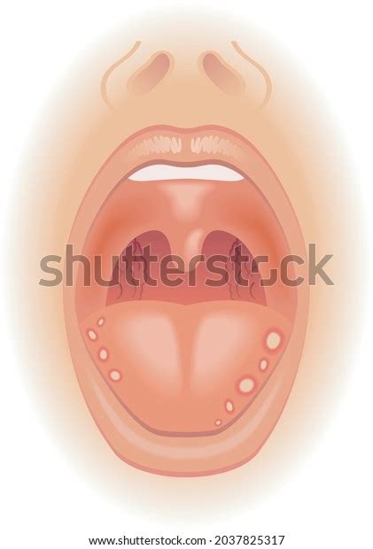 Medical Illustration Symptoms Tongue Sores Stock Vector (Royalty Free ...