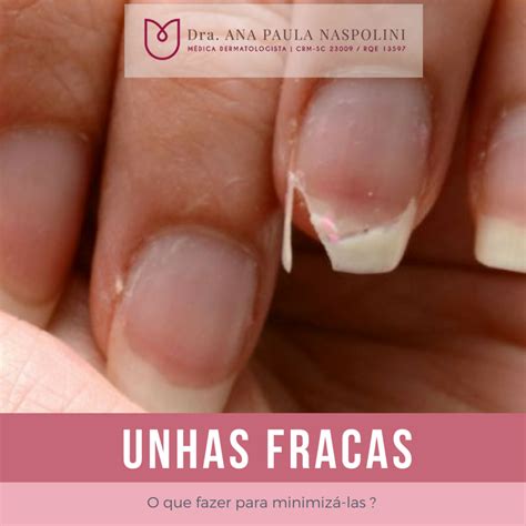 Unhas Fracas E Que Descamam - O que você precisa saber sobre UNHAS FRACAS – Dra. Ana Paula Naspolini ...