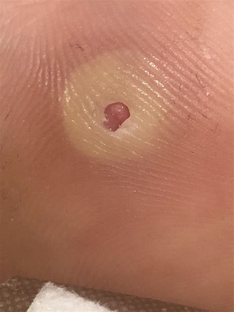Plantar Wart With Seeds at Christopher Ardoin blog