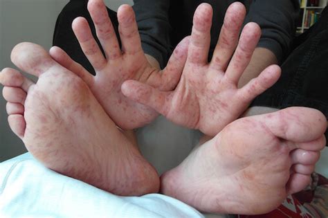 How Long is Hand Foot and Mouth Disease Contagious? | DrGreene