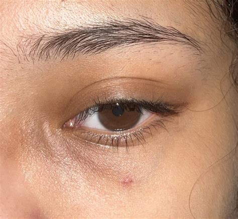 I’ve had this red dot on my face for over 9 months. Does anyone know ...