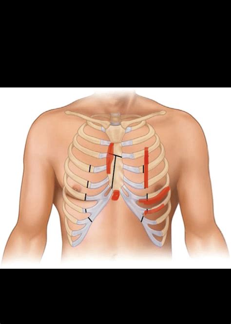 173 best r/costochondritis images on Pholder | A chart of stretches