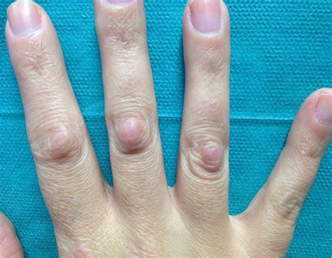 hard lump  finger joint  skin xvpvke