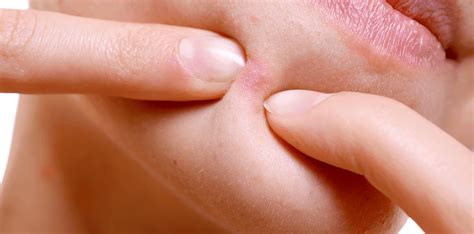 Popping Big Zits And Cysts