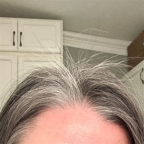 5 Things I did to Reverse Hair Loss after Losing 100+ pounds on a GLP-1