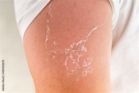 peeling of skin after burned by sunlight. not using sunscreen. sunburn ...
