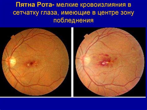 Инфекционный эндокардит - online presentation