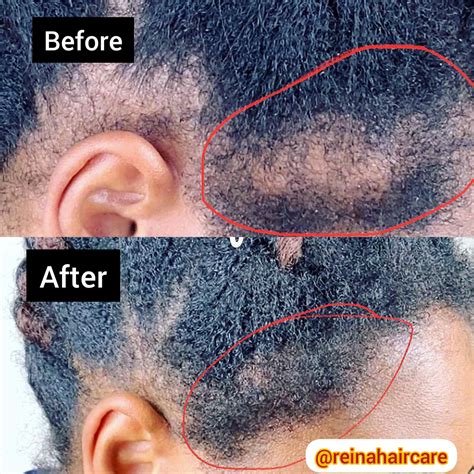 derma roller and hair loss 2