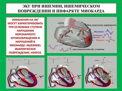 ЭКГ-признаки гипертрофии миокарда желудочков и предсердий. ЭКГ при ИБС ...
