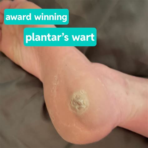 I know I have very very dry skin. I suffer from bad ocd and Im trying