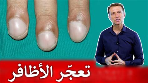 الأظافر التي تدل على مشاكل خفية مثل أمراض الكبد والقلب - YouTube