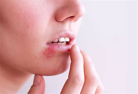 Epstein-Barr Virus - Homeopathic Medicines for EBV - DrHomeo