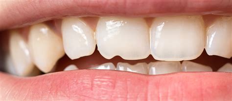 variety  enamel composition  predict  tooth health news