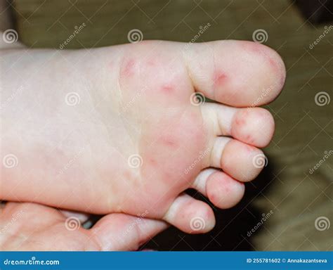 Enterovirus Feet Rash on the Body of a Child. Cocksackie Virus Rash ...