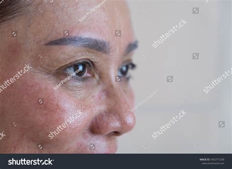 16 Undereye Filler Images, Stock Photos & Vectors | Shutterstock