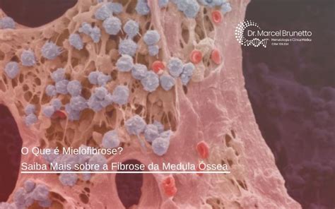 O Que É Mielofibrose - O Que é Mielofibrose? Saiba Mais sobre a Fibrose da Medula Óssea - Dr ...