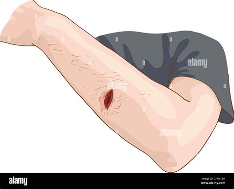 plaie jambe banque dimages vectorielles alamy