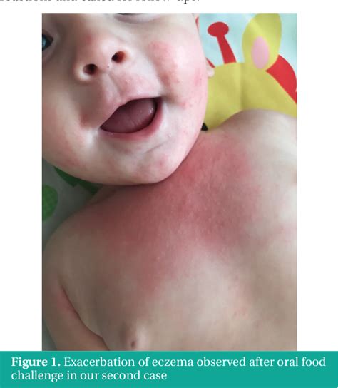 Alergia A Banana Em Bebe - Banana Allergic Response at Josephine Blumberg blog